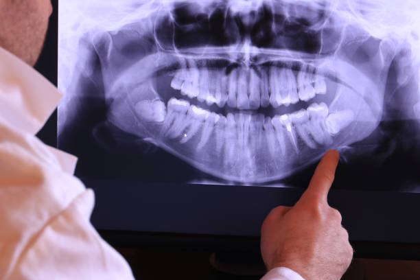 Best Emergency Wisdom Teeth Removal in Lexington Hills, CA