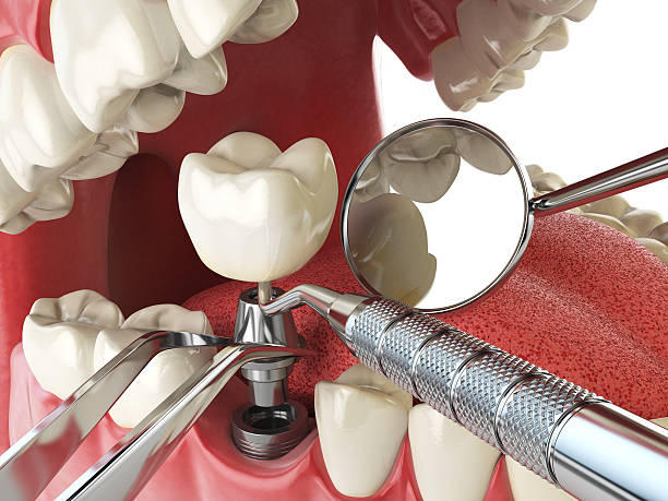 Best Emergency Broken Tooth Repair in Lexington Hills, CA