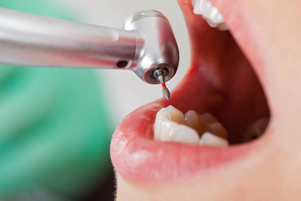 Best Emergency Tooth Extraction in Lexington Hills, CA